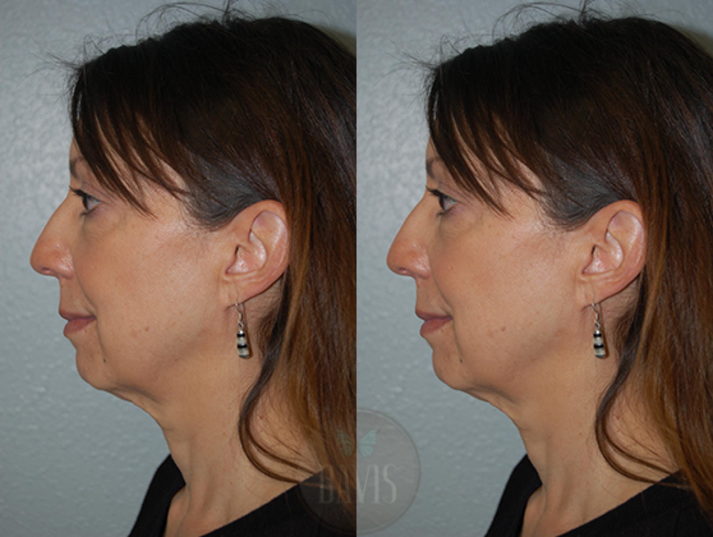 Before & After Chin Augmentation Case 1146 View 2 View in Tampa, FL