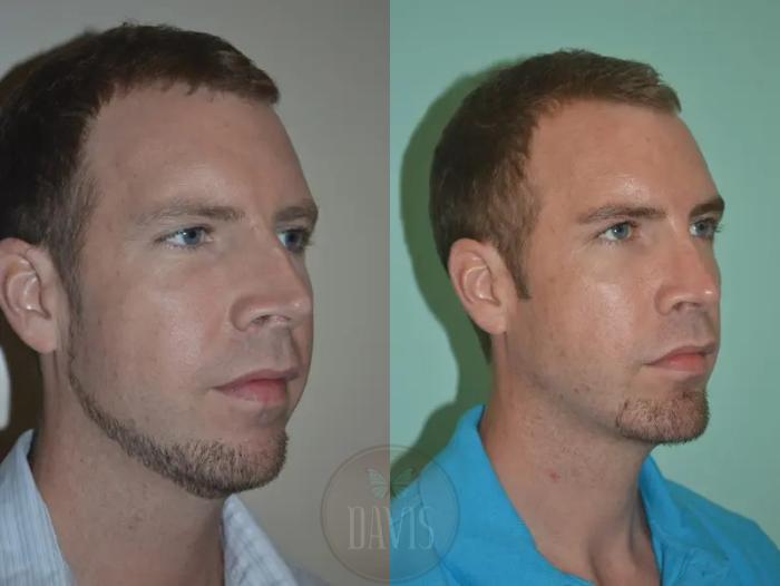 Before & After Chin Augmentation Case 1147 View 1 View in Tampa, FL