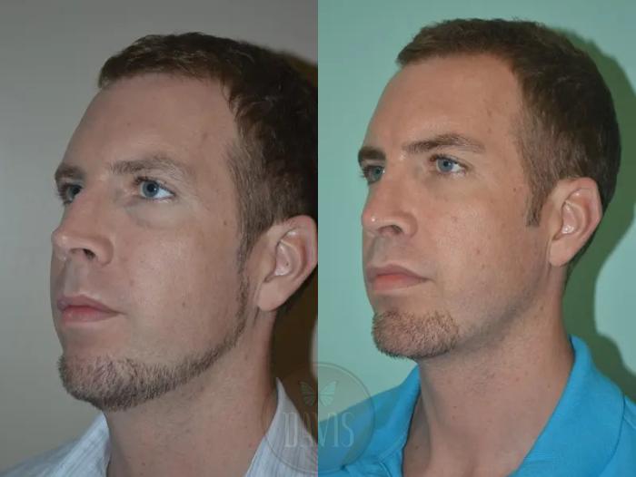 Before & After Chin Augmentation Case 1147 View 2 View in Tampa, FL