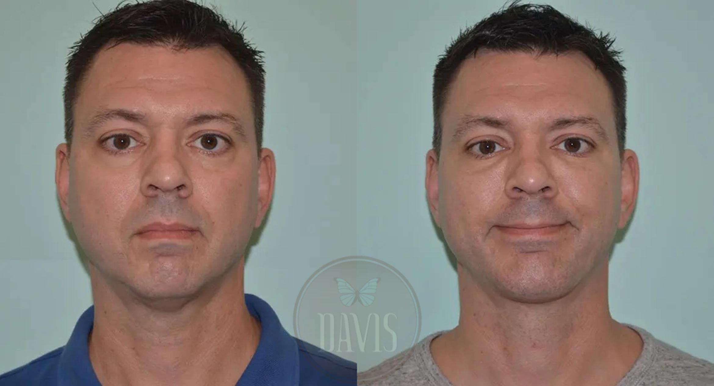 Before & After Chin Augmentation Case 1148 View 1 View in Tampa, FL