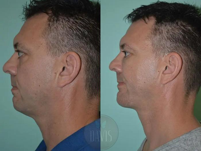 Before & After Chin Augmentation Case 1148 View 2 View in Tampa, FL
