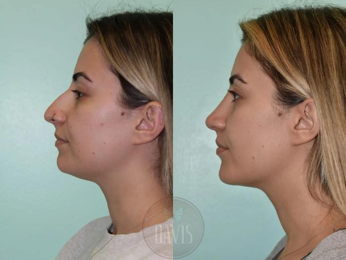 Before & After Chin Augmentation Case 1150 View 2 View in Tampa, FL