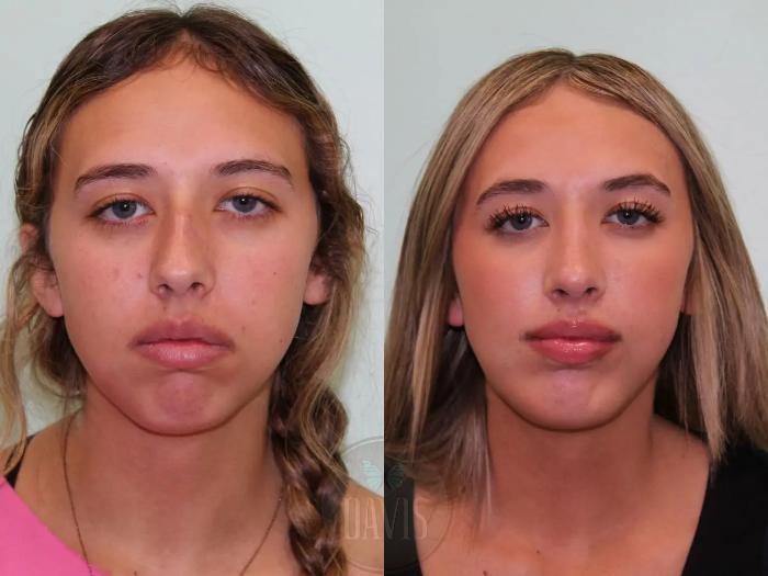Before & After Chin Augmentation Case 1151 View 1 View in Tampa, FL