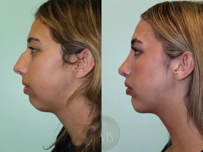Before & After Chin Augmentation Case 1151 View 2 View in Tampa, FL