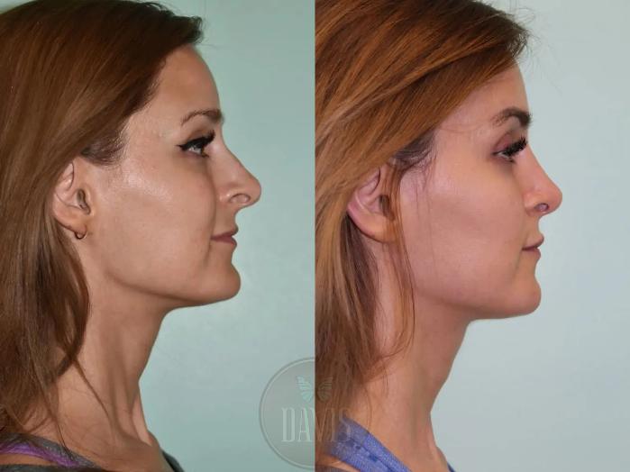 Before & After Chin Reduction Case 1138 View 1 View in Tampa, FL