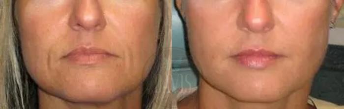 Before & After Cosmetic Injectables and Fillers Case 1048 View 1 View in Tampa, FL