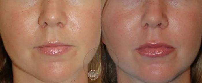 Before & After Cosmetic Injectables and Fillers Case 1049 View 1 View in Tampa, FL