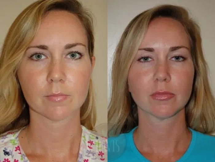 Before & After Cosmetic Injectables and Fillers Case 1049 View 2 View in Tampa, FL