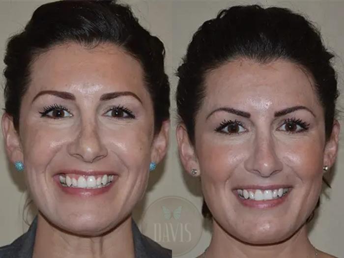Before & After Cosmetic Injectables and Fillers Case 1050 View 1 View in Tampa, FL