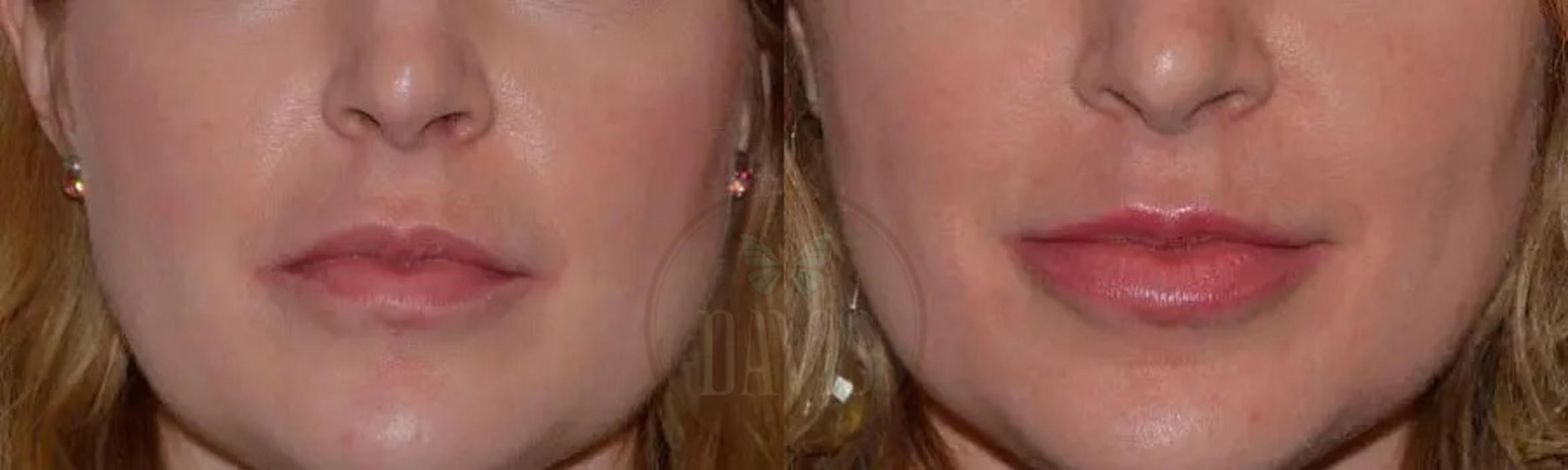 Before & After Cosmetic Injectables and Fillers Case 1051 View 1 View in Tampa, FL