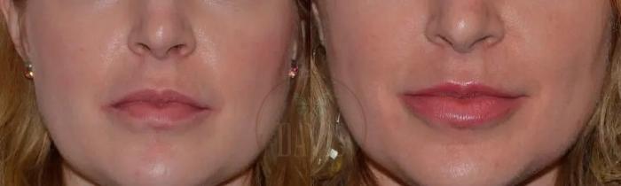 Before & After Cosmetic Injectables and Fillers Case 1051 View 1 View in Tampa, FL