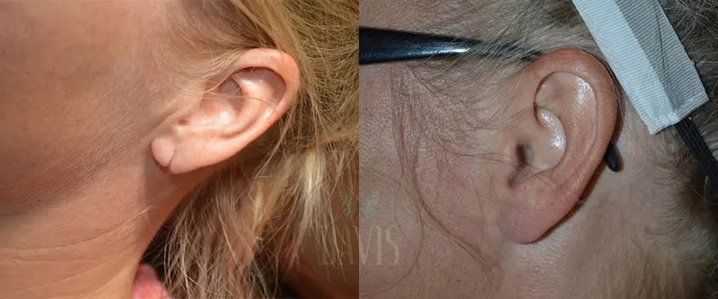 Before & After Earlobe Repair Case 1136 View 1 View in Tampa, FL