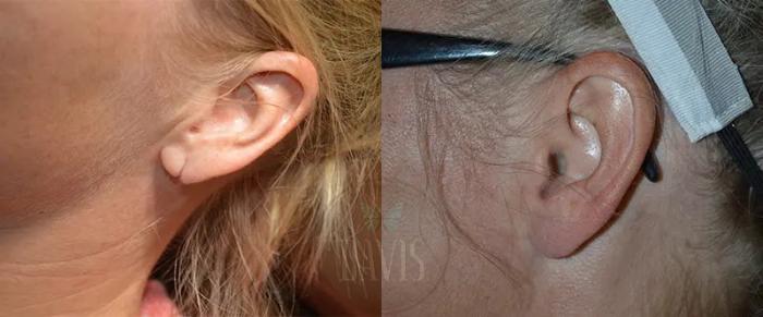 Before & After Earlobe Repair Case 1136 View 1 View in Tampa, FL