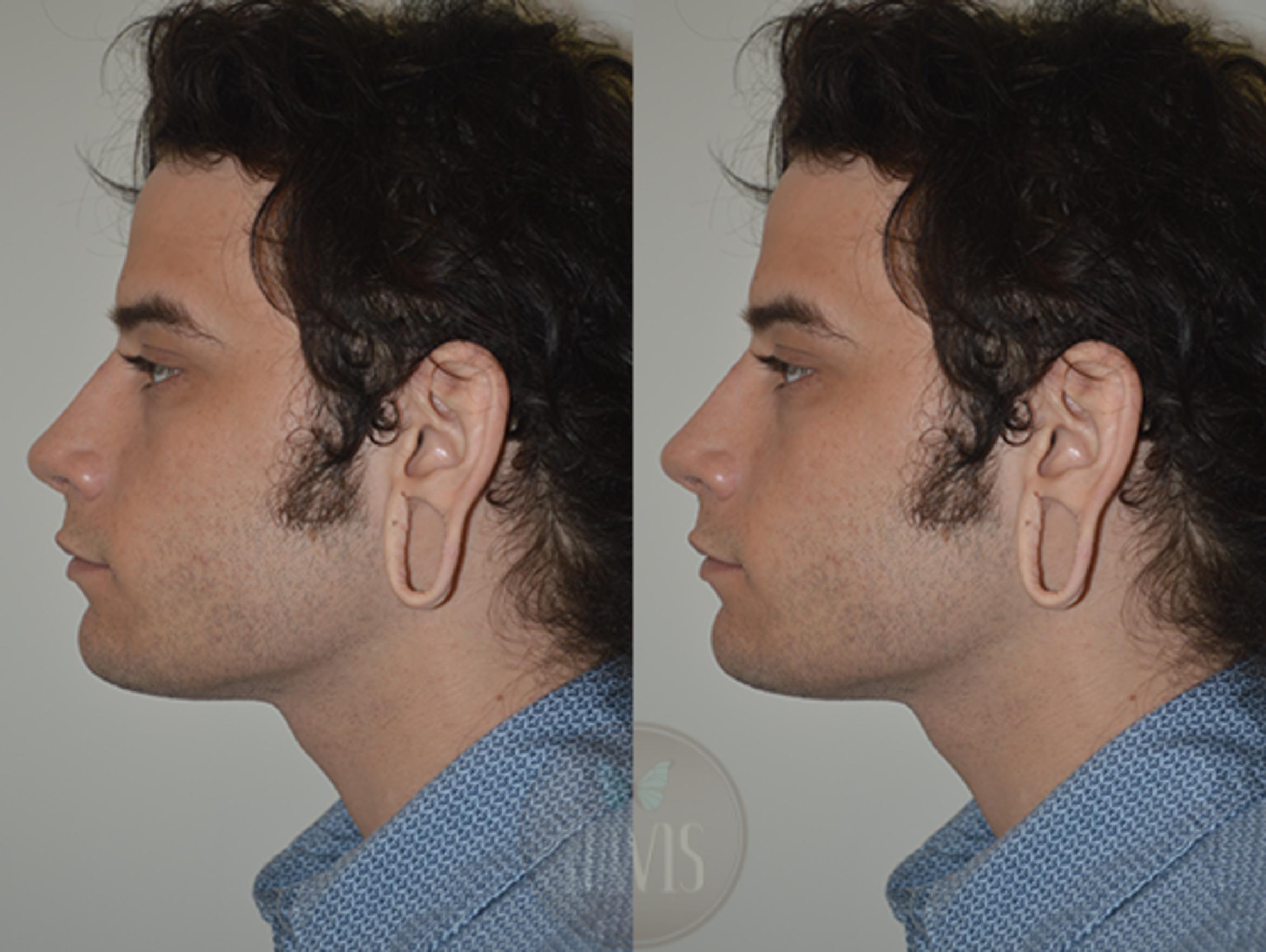Before & After Earlobe Repair Case 1137 View 1 View in Tampa, FL