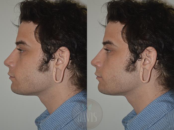 Before & After Earlobe Repair Case 1137 View 1 View in Tampa, FL