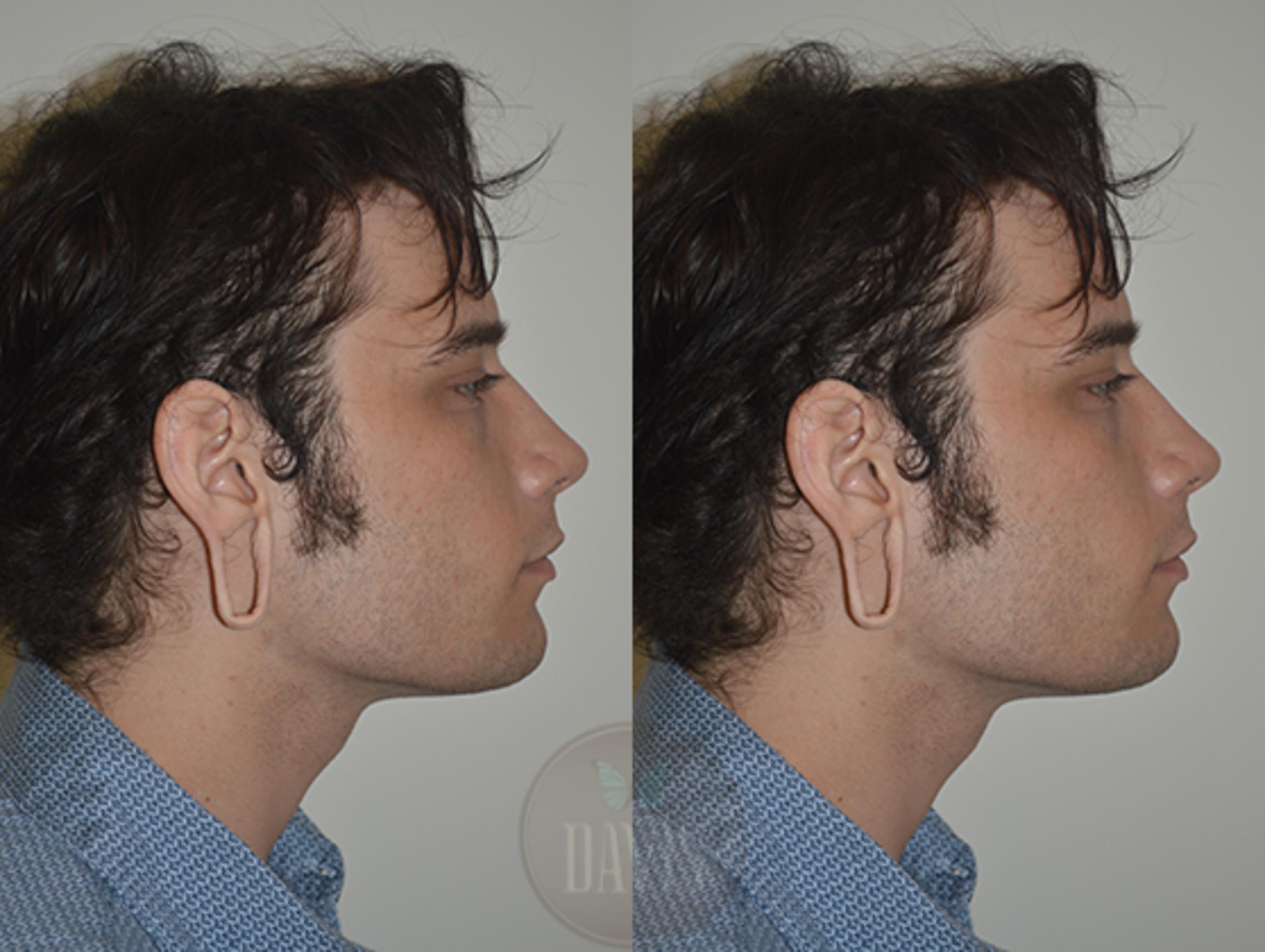 Before & After Earlobe Repair Case 1137 View 2 View in Tampa, FL