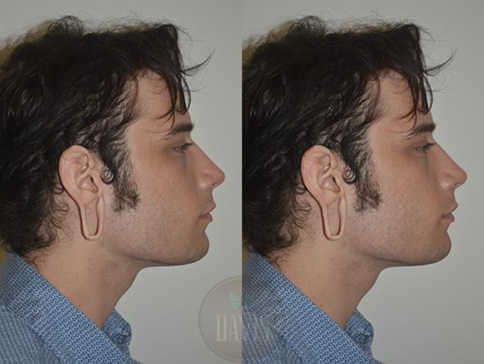 Before & After Earlobe Repair Case 1137 View 2 View in Tampa, FL