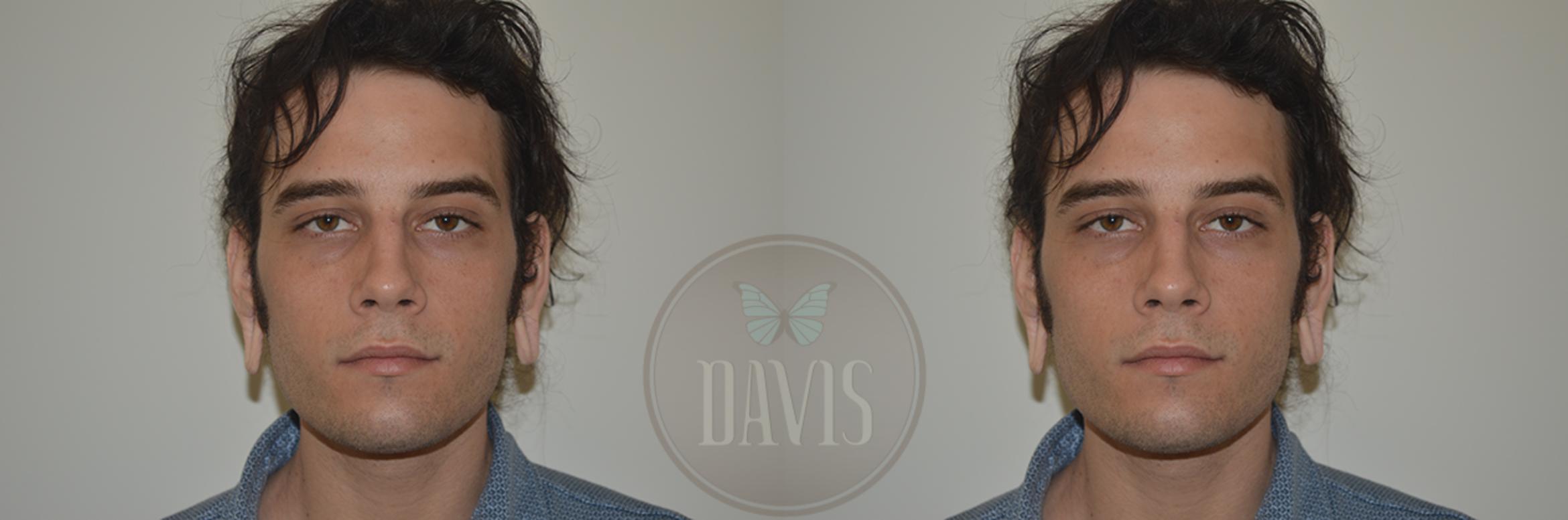 Before & After Earlobe Repair Case 1137 View 3 View in Tampa, FL