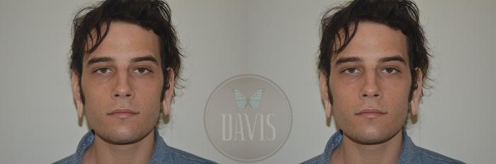 Before & After Earlobe Repair Case 1137 View 3 View in Tampa, FL