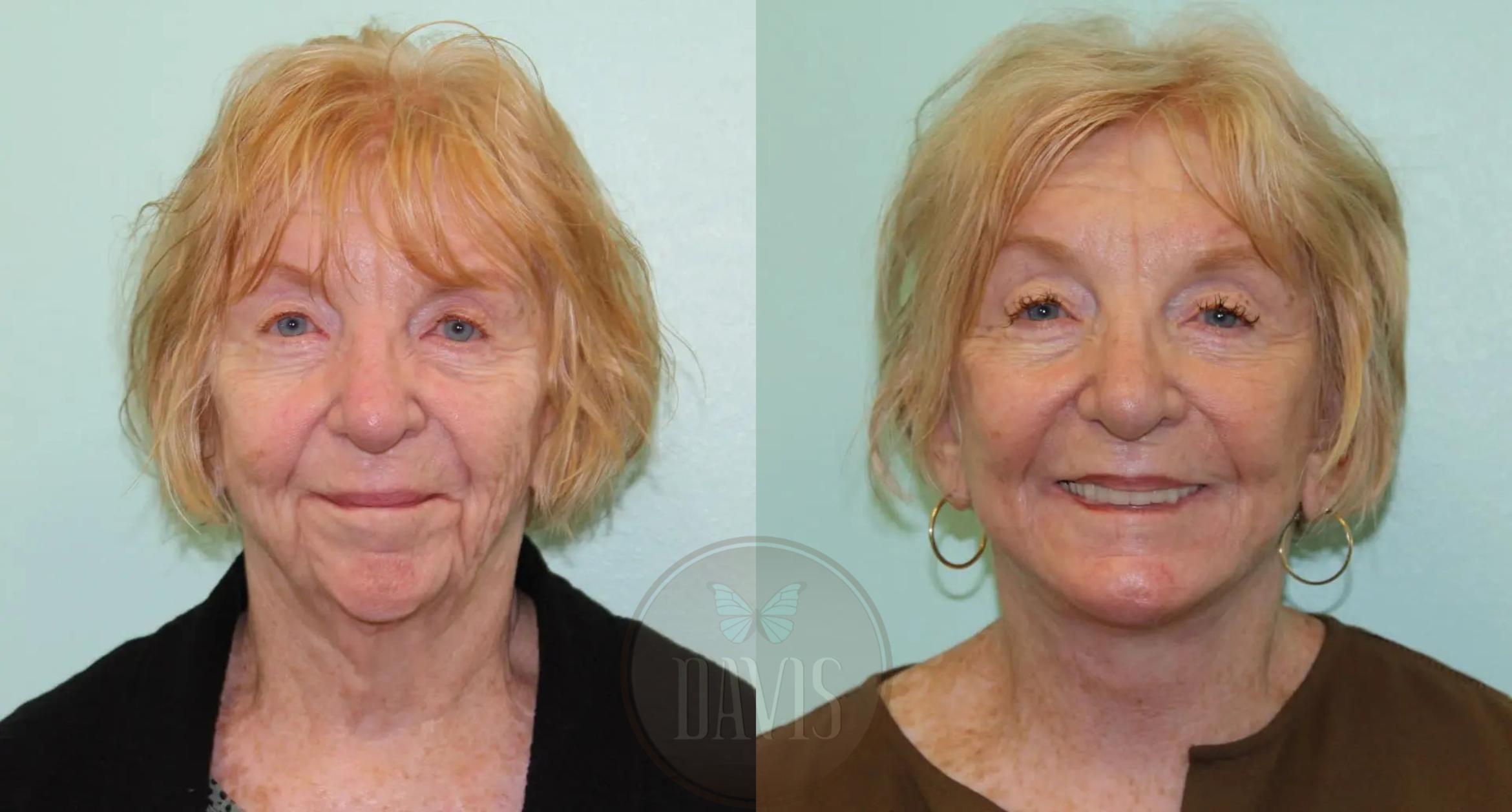 Before & After Facelift Case 1122 View 1 View in Tampa, FL