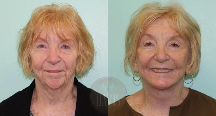 Before & After Facelift Case 1122 View 1 View in Tampa, FL
