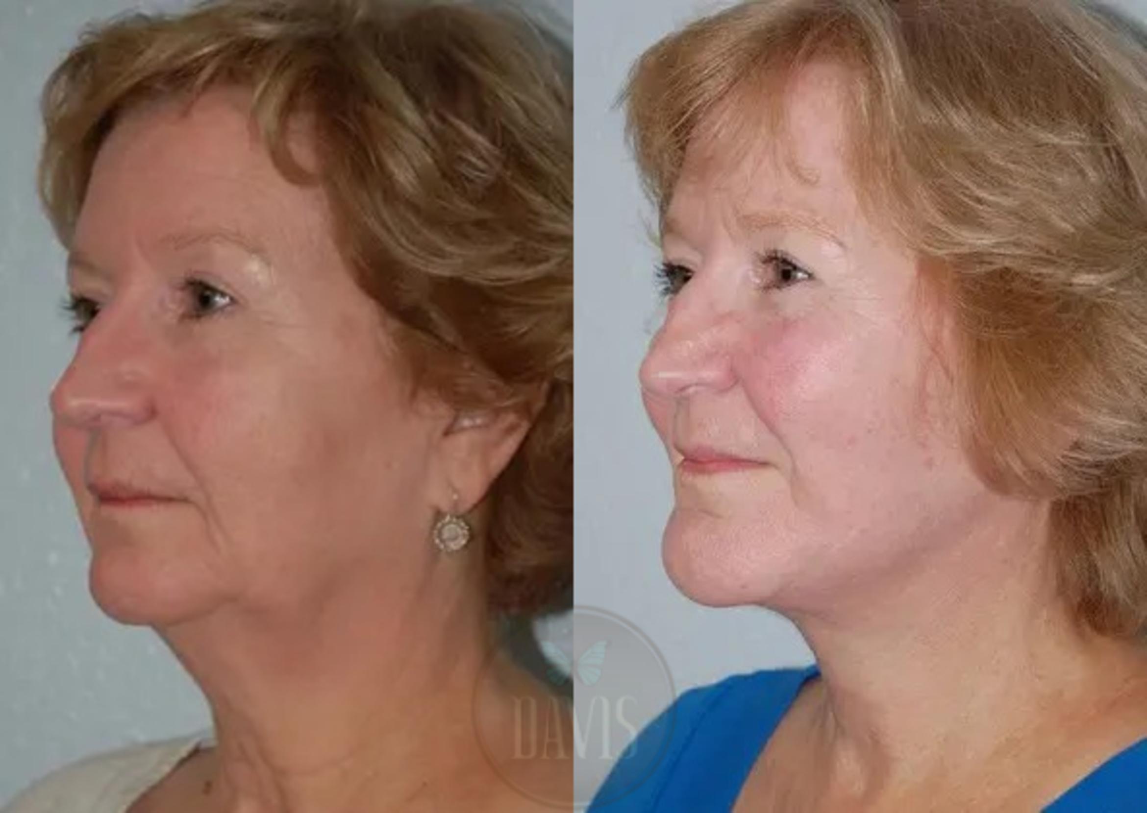 Before & After Facelift Case 1123 View 1 View in Tampa, FL