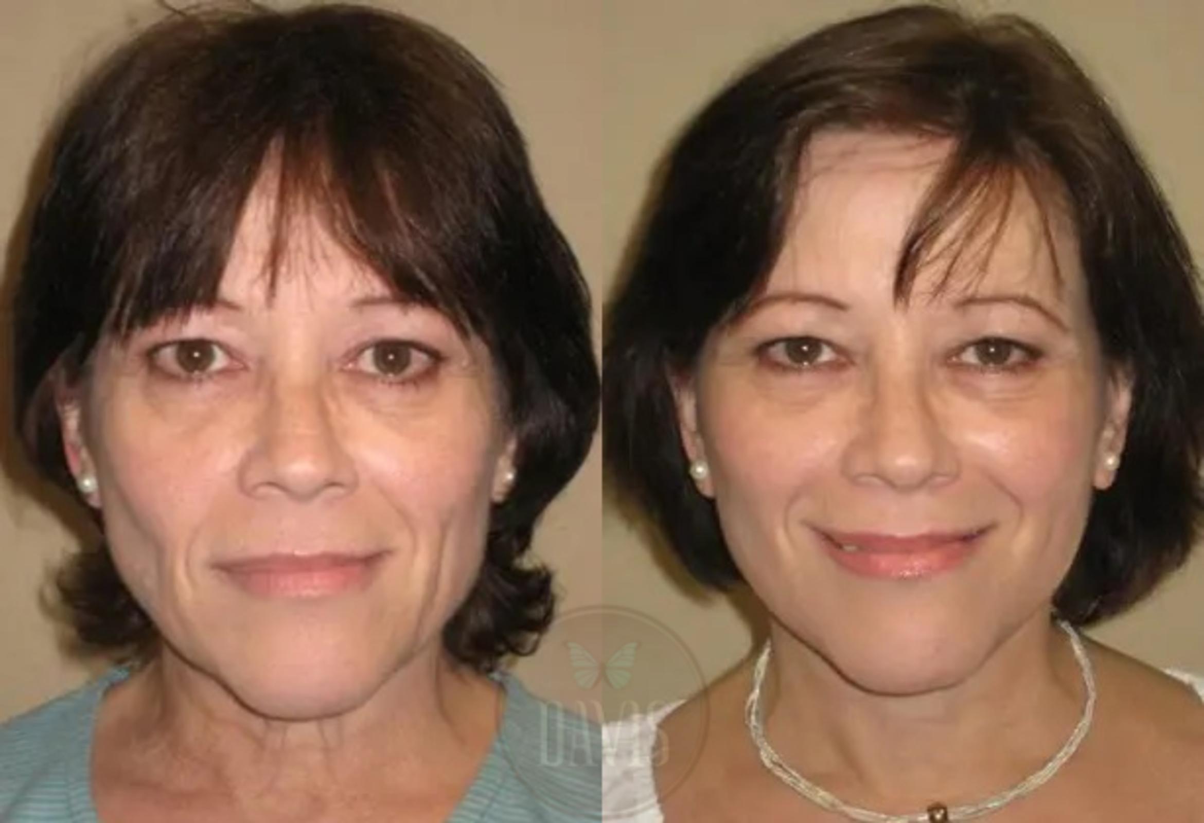 Before & After Facelift Case 1124 View 1 View in Tampa, FL