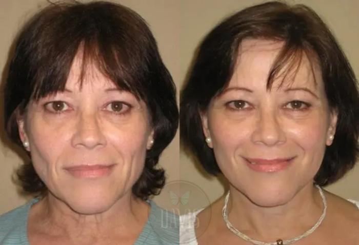 Before & After Facelift Case 1124 View 1 View in Tampa, FL