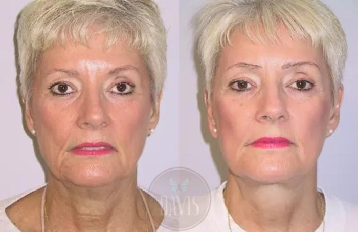 Before & After Facelift Case 1125 View 1 View in Tampa, FL