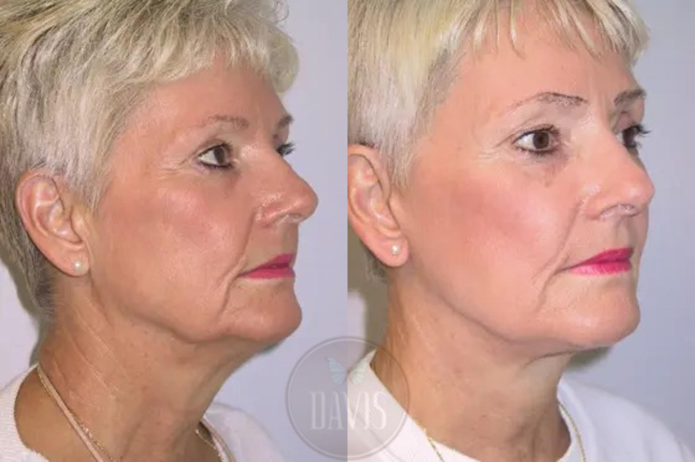 Before & After Facelift Case 1125 View 2 View in Tampa, FL