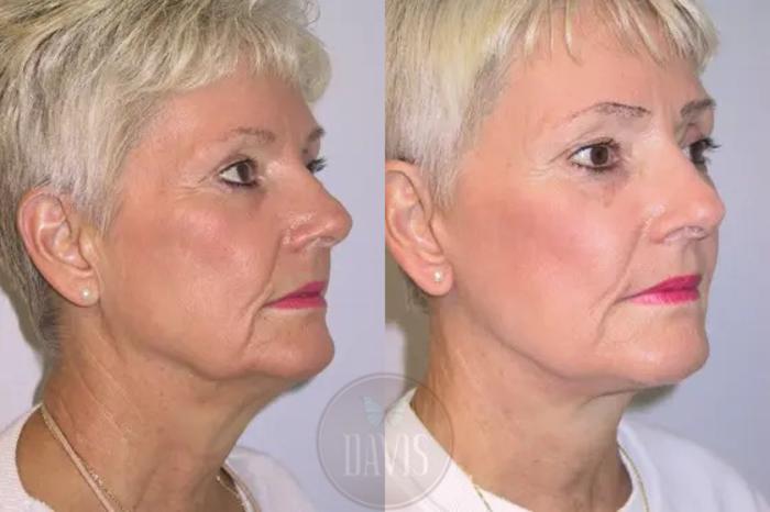 Before & After Facelift Case 1125 View 2 View in Tampa, FL