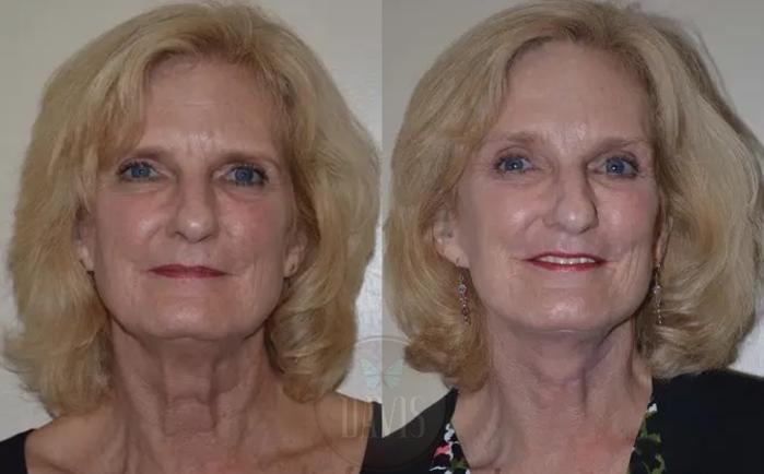 Before & After Facelift Case 1126 View 1 View in Tampa, FL