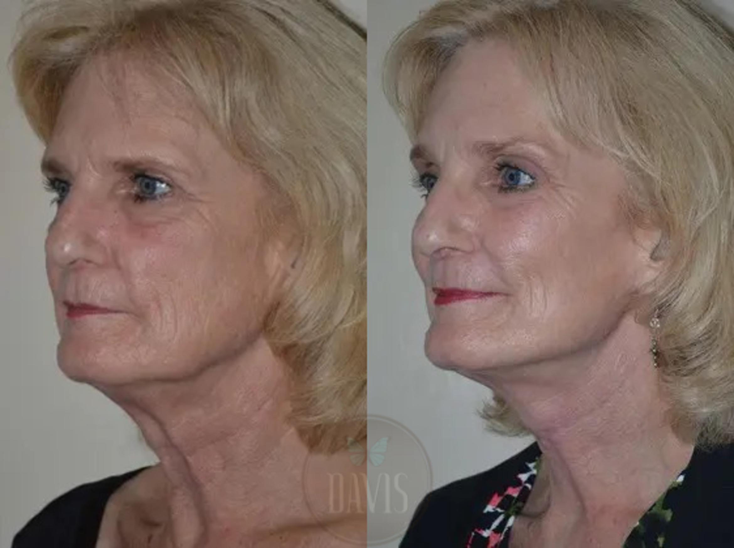 Before & After Facelift Case 1126 View 2 View in Tampa, FL