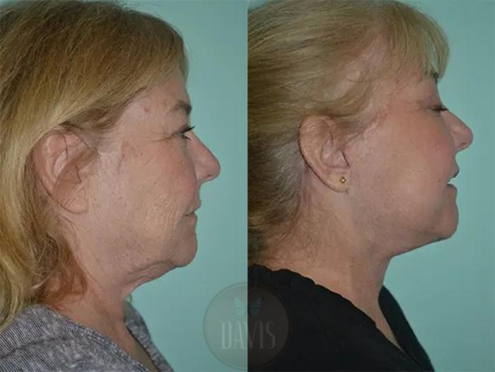 Before & After Facelift Case 1127 View 1 View in Tampa, FL