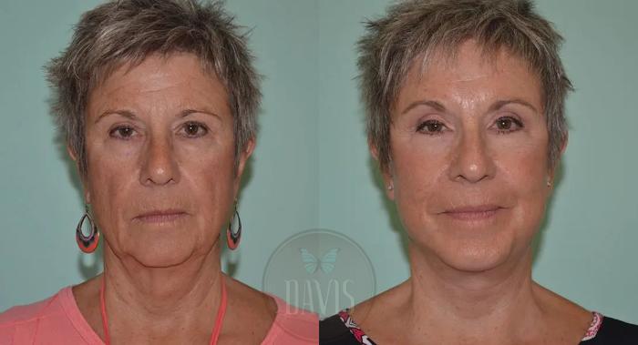 Before & After Facelift Case 1128 View 1 View in Tampa, FL
