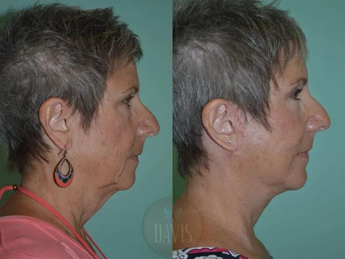 Before & After Facelift Case 1128 View 2 View in Tampa, FL