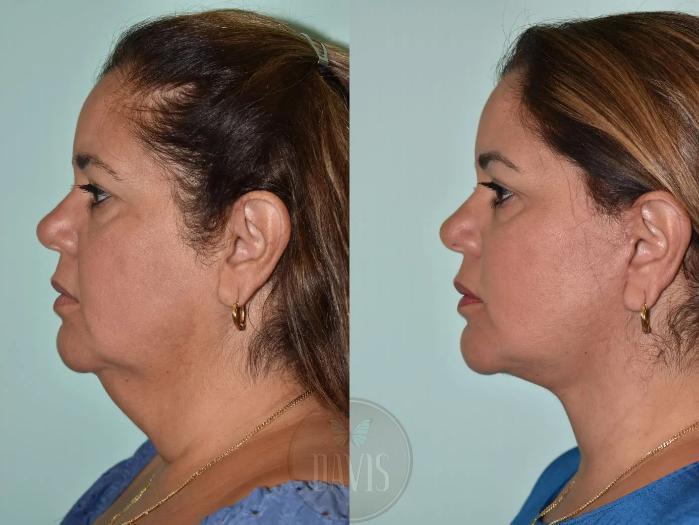 Before & After Facelift Case 1129 View 1 View in Tampa, FL