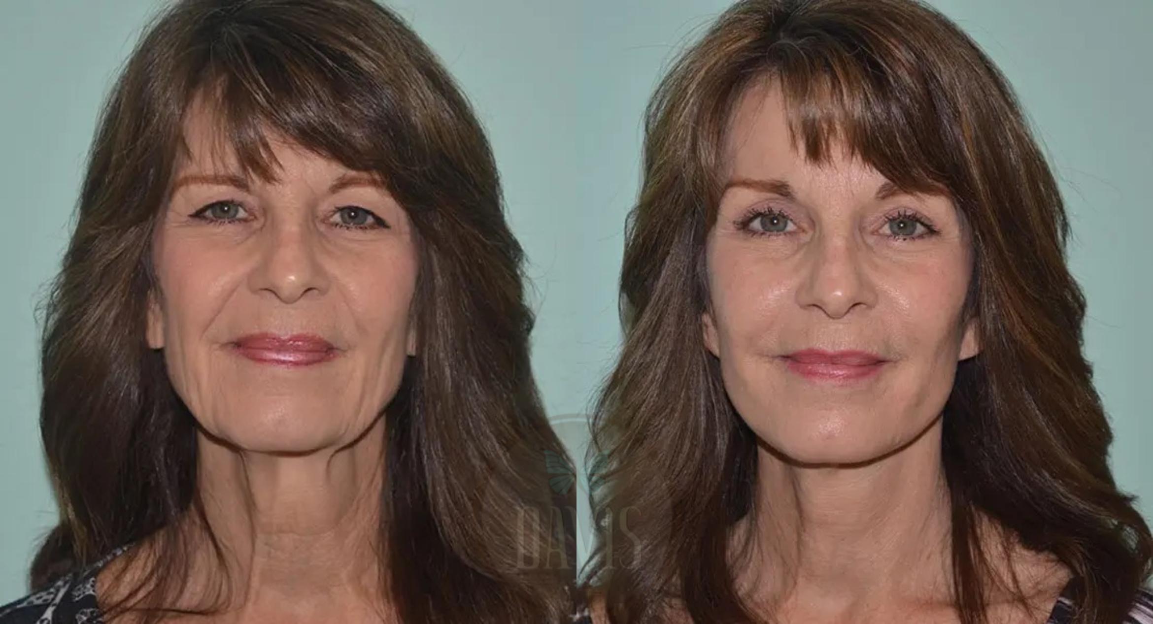 Before & After Facelift Case 1130 View 1 View in Tampa, FL