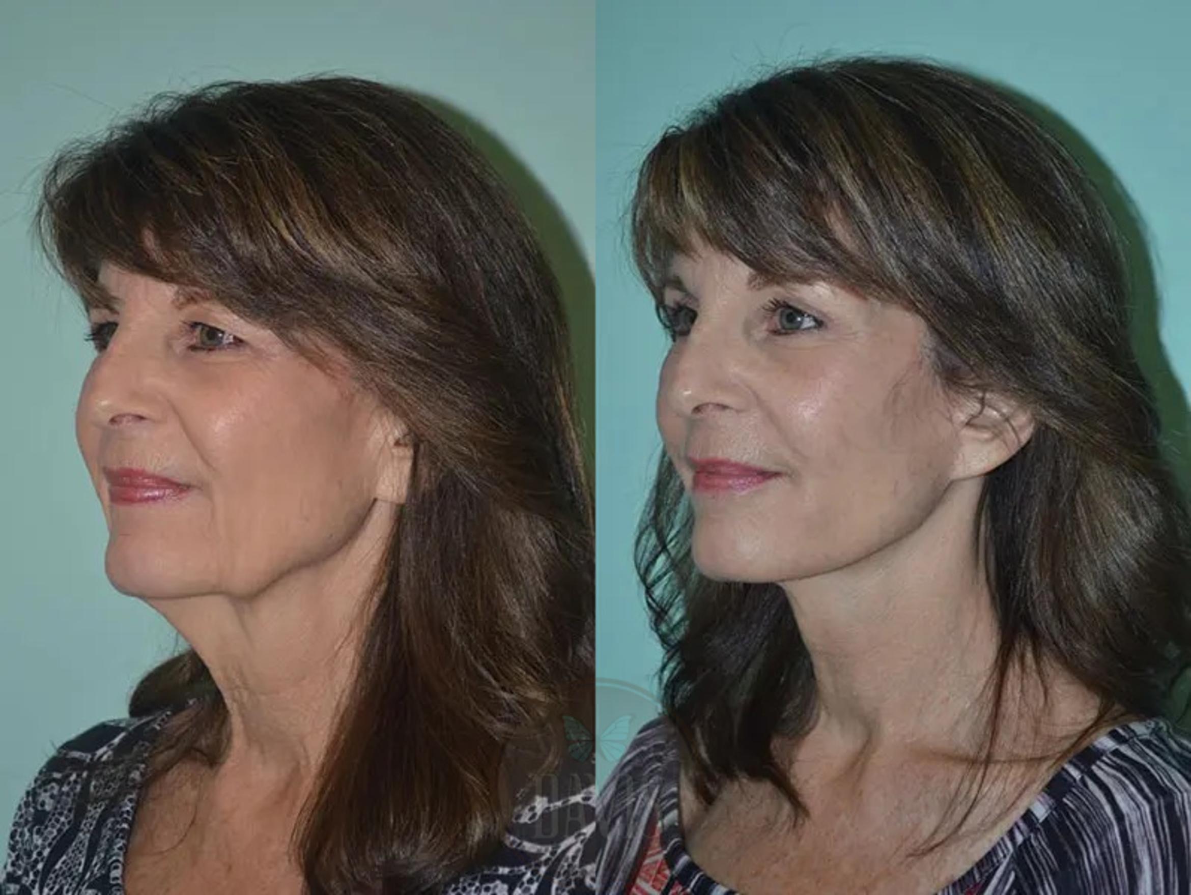 Before & After Facelift Case 1130 View 2 View in Tampa, FL