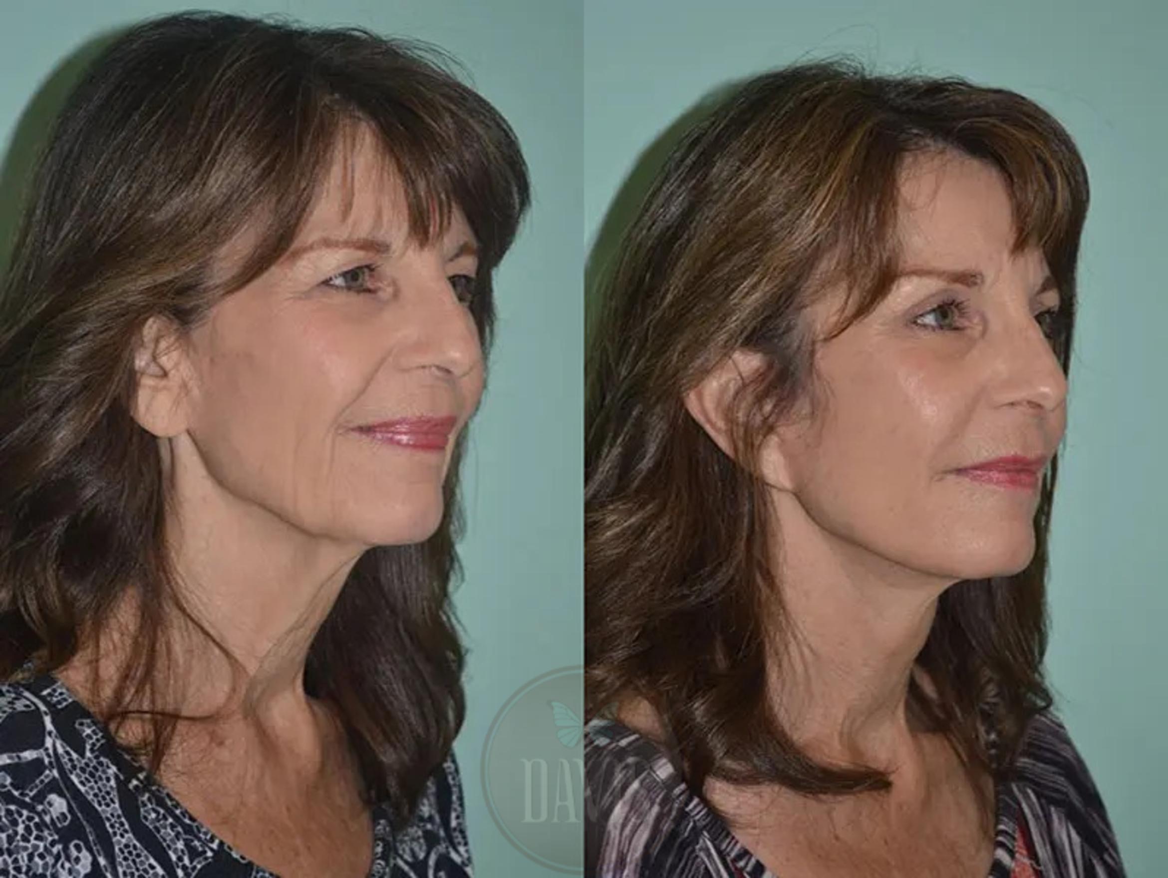 Before & After Facelift Case 1130 View 3 View in Tampa, FL