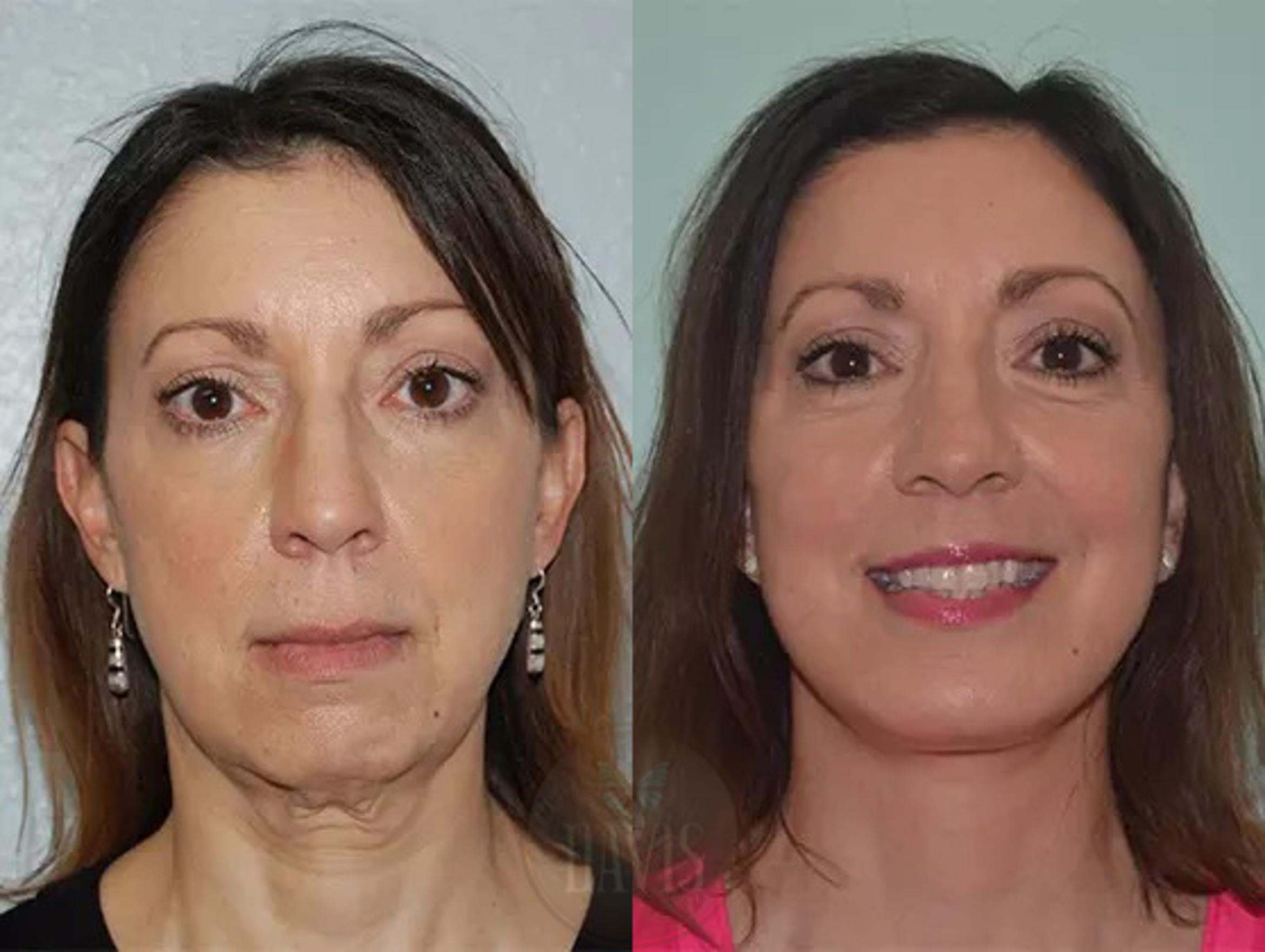 Before & After Facelift Case 1131 View 1 View in Tampa, FL