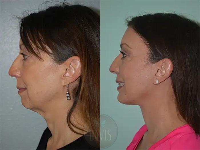 Before & After Facelift Case 1131 View 2 View in Tampa, FL