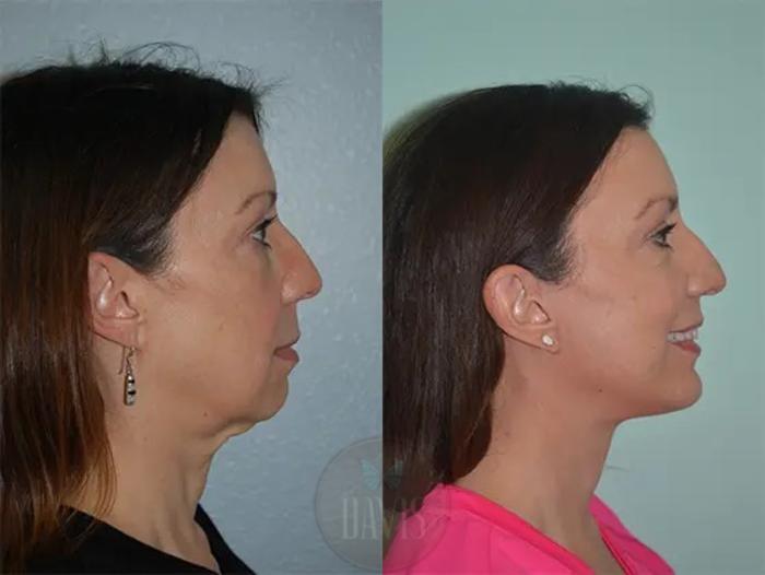Before & After Facelift Case 1131 View 3 View in Tampa, FL