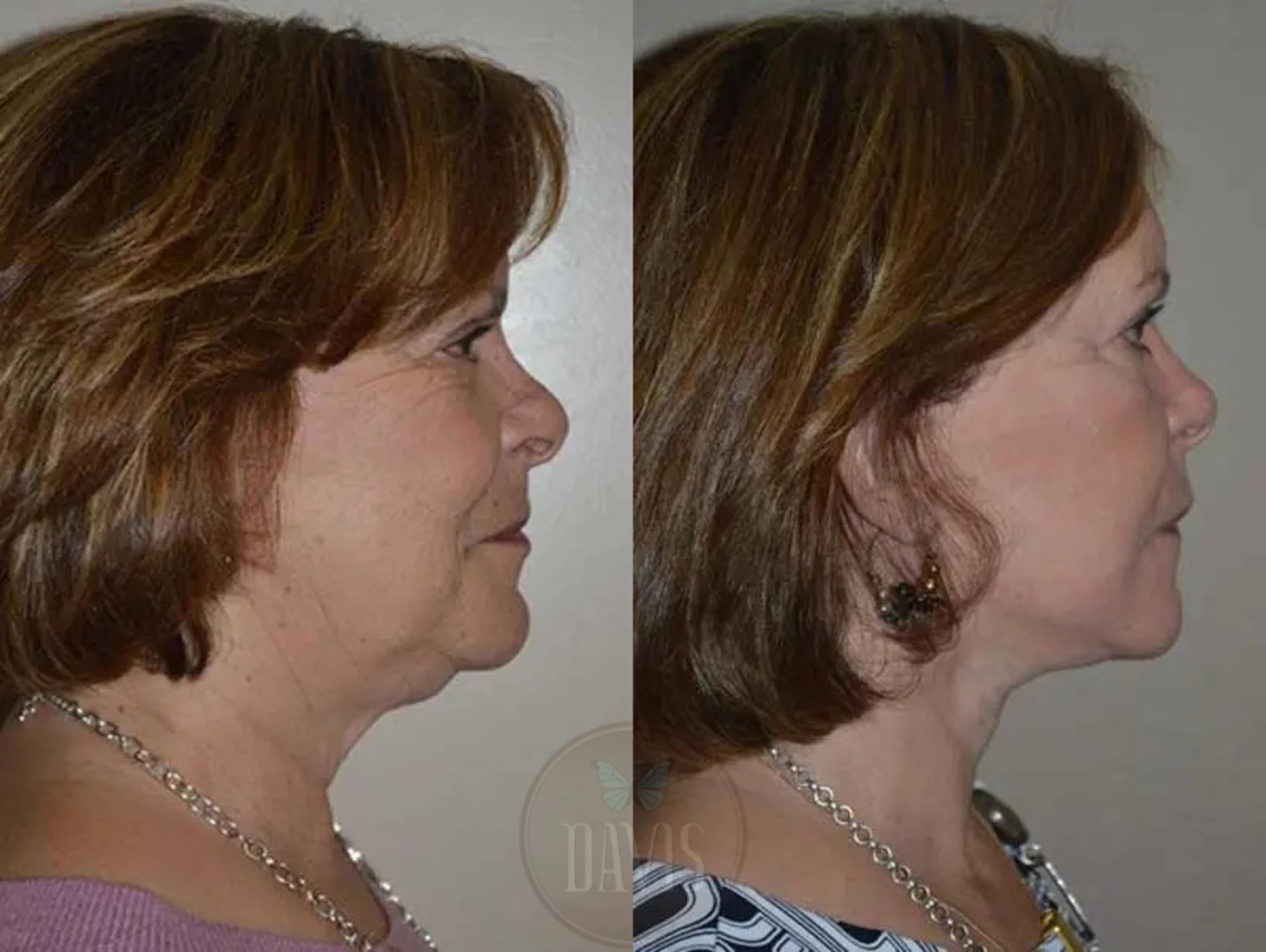 Before & After Facelift Case 1132 View 1 View in Tampa, FL
