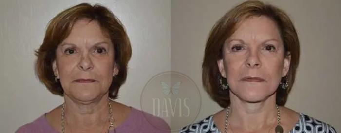 Before & After Facelift Case 1132 View 2 View in Tampa, FL