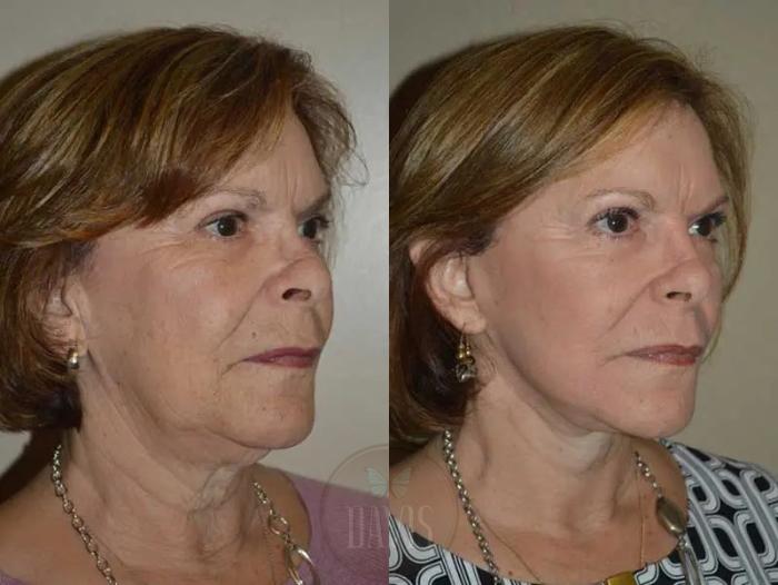 Before & After Facelift Case 1132 View 3 View in Tampa, FL