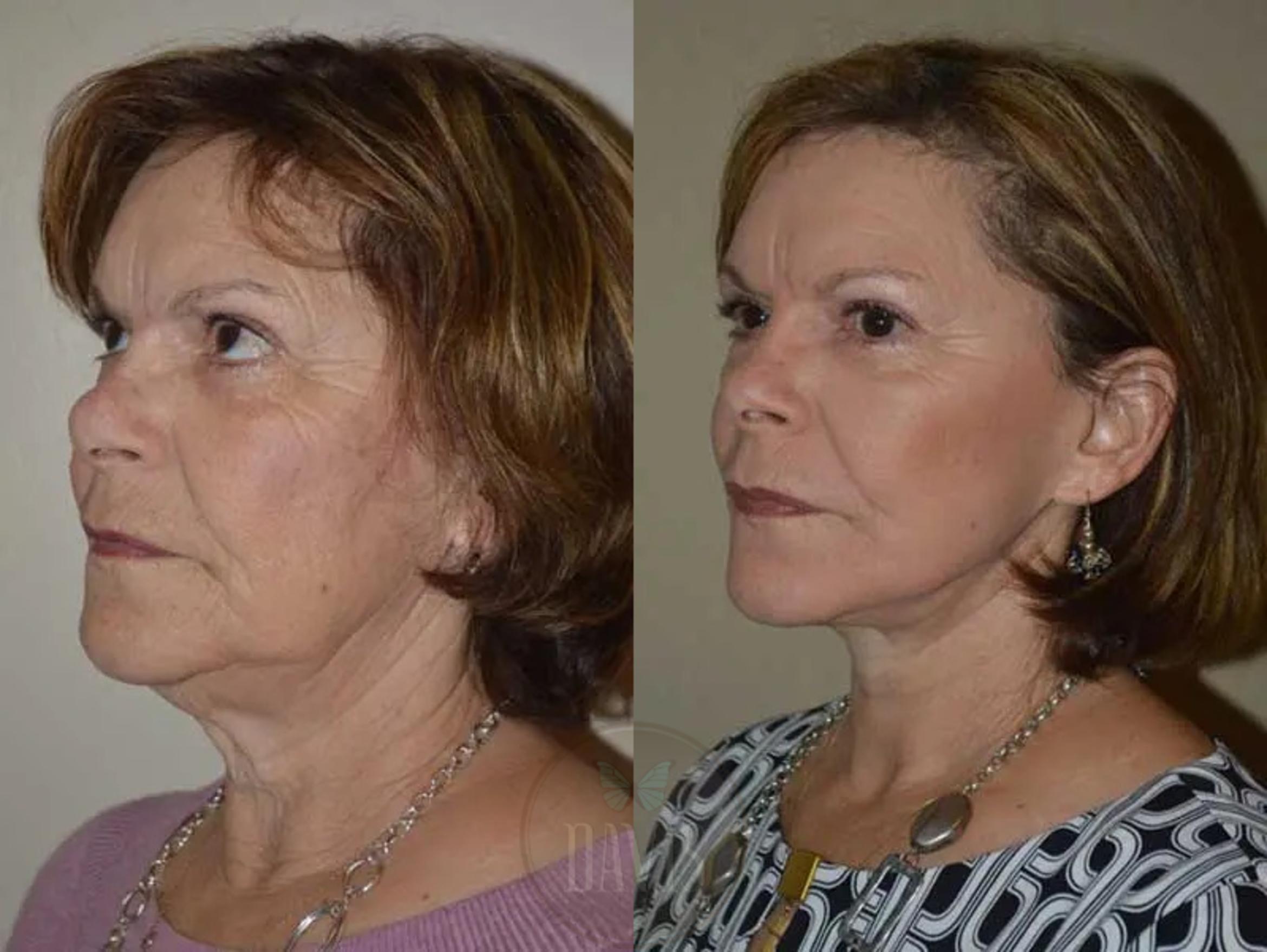 Before & After Facelift Case 1132 View 4 View in Tampa, FL