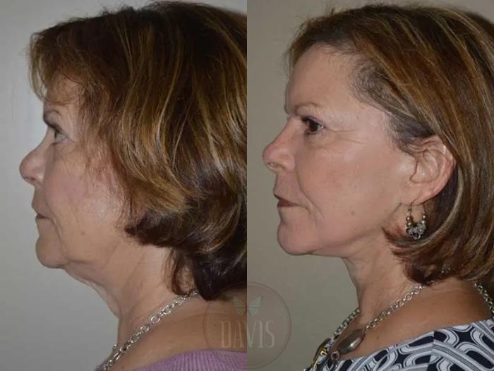 Before & After Facelift Case 1132 View 5 View in Tampa, FL