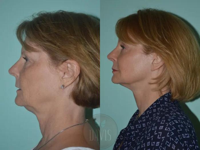 Before & After Facelift Case 1133 View 1 View in Tampa, FL