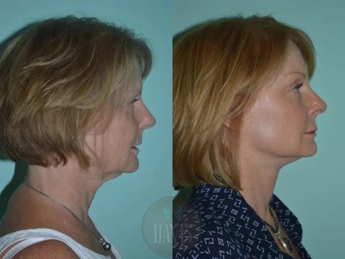 Before & After Facelift Case 1133 View 2 View in Tampa, FL